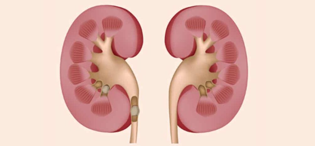 urolithiasis as a cause of calculous prostatitis